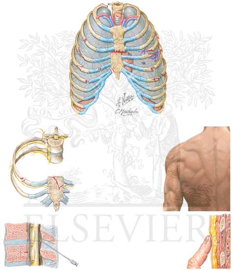 Watermarked preview of unlabeled image: Rib and Sternal Fractures