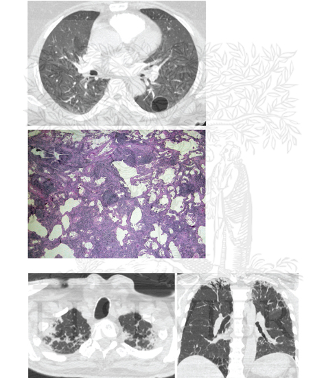 Lymphoid Interstitial Pneumonia