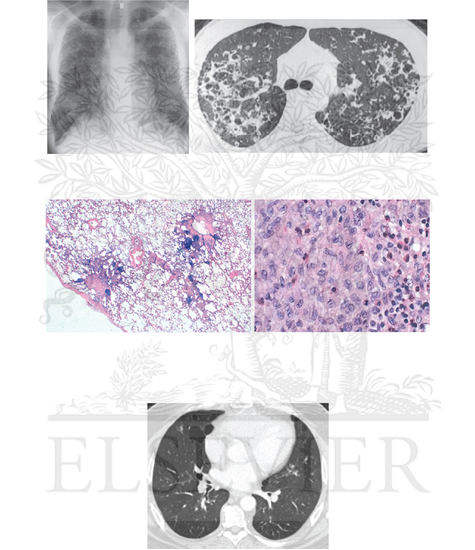 Diffuse Cystic Lung Diseases (Continued)