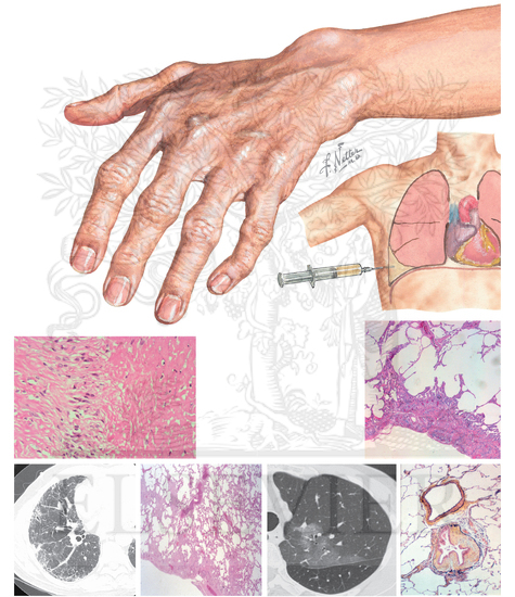 Watermarked preview of unlabeled image: Rheumatoid Arthritis