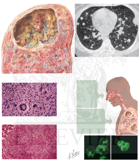 Watermarked preview of unlabeled image: Pulmonary Vasculitis