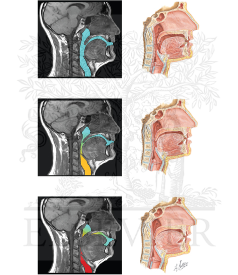 Watermarked preview of unlabeled image: Sleep-Disordered Breathing