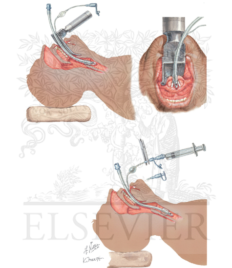 Endotracheal Intubation