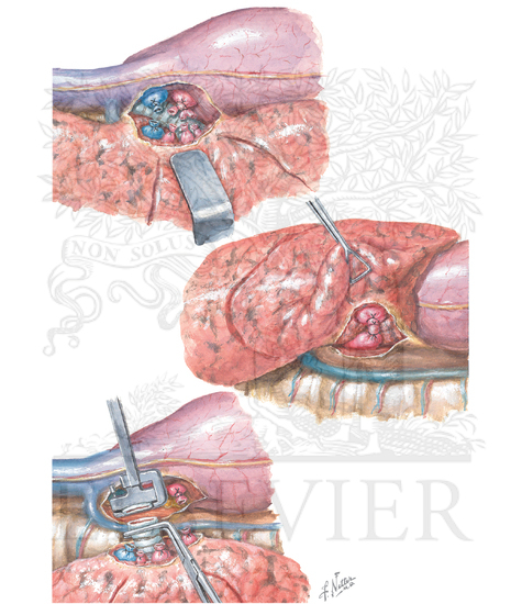 Watermarked preview of unlabeled image: Pneumonectomy (Continued)