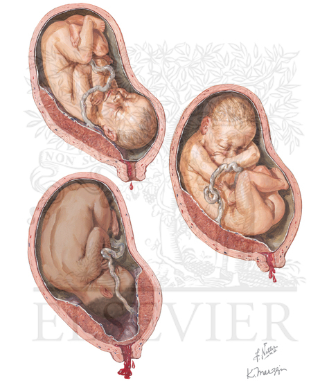 Placenta Previa