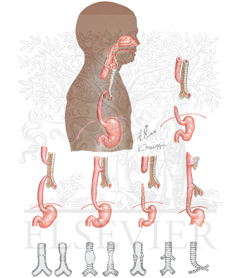 Congenital Anomalies of the Lower Airway