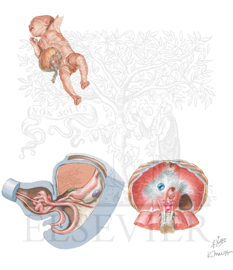 Umbilical Hernia