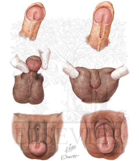 Watermarked preview of unlabeled image: Hypospadias and Epispadias