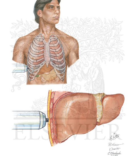 Watermarked preview of unlabeled image: Noninvasive Assessments for Hepatic Fibrosis