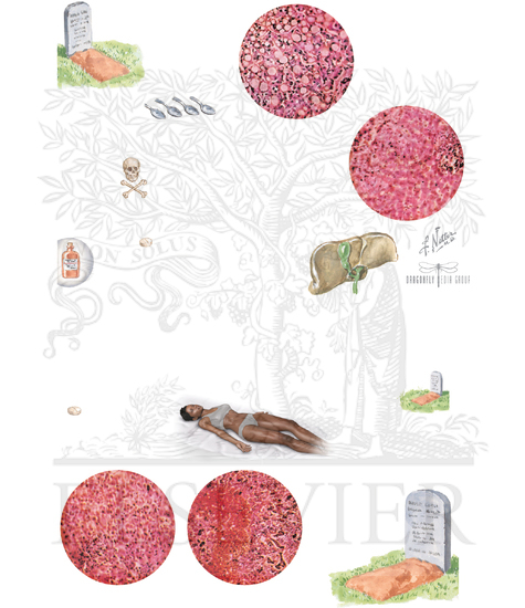 Watermarked preview of unlabeled image: Drug-Induced Hepatic Injuries