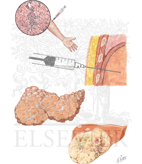 Watermarked preview of unlabeled image: Hepatitis C