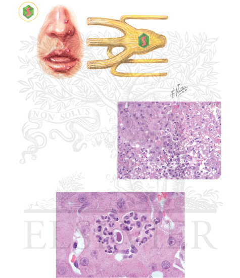 Watermarked preview of unlabeled image: Herpes Simplex Virus and Cytomegalovirus