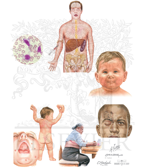 Watermarked preview of unlabeled image: Epstein-Barr Virus and Varicella-Zoster Virus