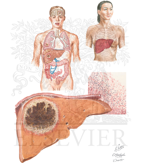 Watermarked preview of unlabeled image: Amebiasis