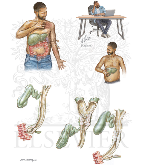 Watermarked preview of unlabeled image: Clinical Manifestations of Primary Sclerosing Cholangitis