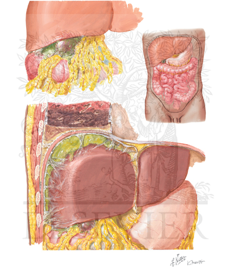 Watermarked preview of unlabeled image: Perforation, Subphrenic Abscess