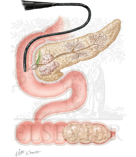 Watermarked preview of unlabeled image: Biochemical Changes in Pancreatic Obstruction