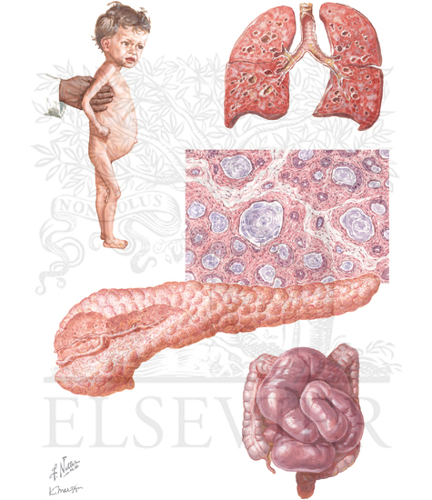 Watermarked preview of unlabeled image: Cystic Fibrosis of the Pancreas