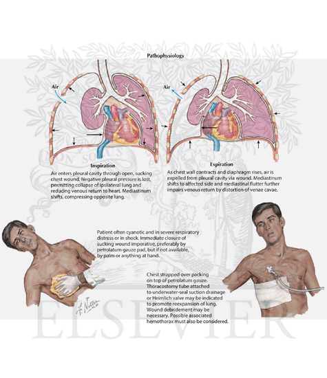 Watermarked preview of labeled image: Pneumothorax