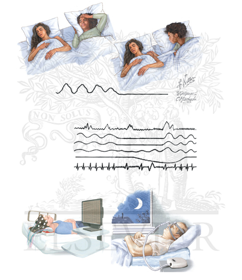 Watermarked preview of unlabeled image: Sleep Apnea