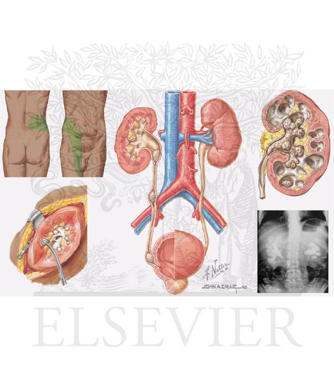 Watermarked preview of unlabeled image: Kidney Stones (Renal Calculi)