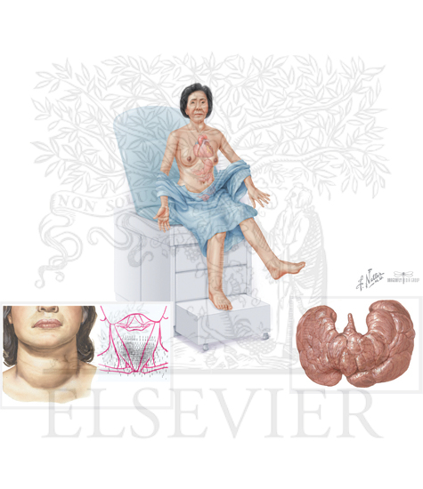 Watermarked preview of unlabeled image: Diseases of Thyroid Function: Hyperthyroidism