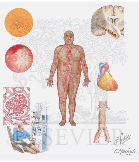 Watermarked preview of unlabeled image: Diabetes Mellitus