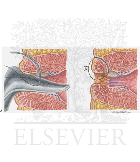 Watermarked preview of labeled image: Inflammatory Bowel Disease (A)