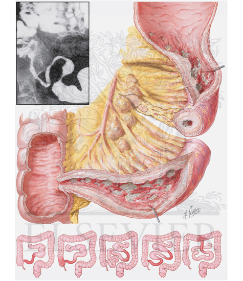 Watermarked preview of unlabeled image: Inflammatory Bowel Disease (B)