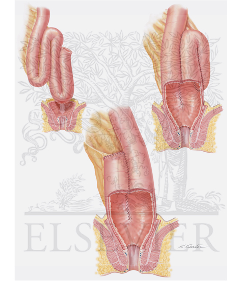 Watermarked preview of unlabeled image: Inflammatory Bowel Disease (C)