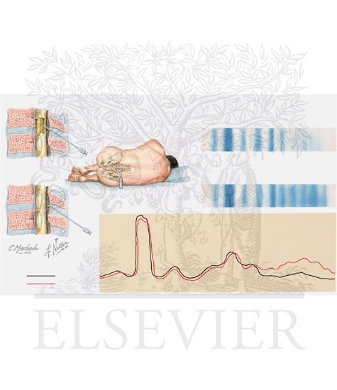 Watermarked preview of unlabeled image: Multiple Sclerosis