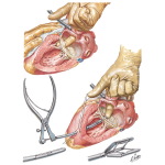 Illustration of Closed Mitral Commissurotomy from the Netter Collection
