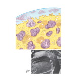 Illustration of Type II Alveolar Cell and Surface-Active Layer from the Netter Collection