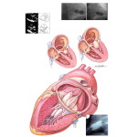 Mitral Balloon Valvuloplasty