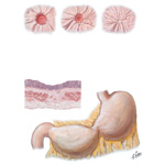 Peptic Ulcer IX - Healing of Gastric Ulcer