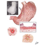 Illustration of Peptic Ulcer II - Subacute Ulcer of Stomach from the Netter Collection