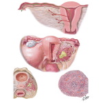 Illustration of Pathways of Infection, Parametritis, Acute Salpingitis I
Endometritis from the Netter Collection