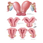 Illustration of Uterine Anomalies: Bicornuate, Septate, and Unicornuate Uterus from the Netter Collection