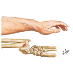 smith fracture nerve smith fracture nerve