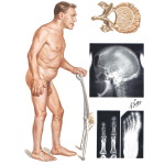 Illustration of Acromegaly from the Netter Collection