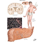 Illustration of Metabolic Injuries III - Wilson Disease from the Netter Collection