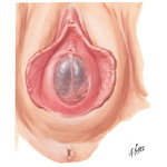 Illustration of Imperforate Hymen from the Netter Collection