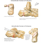 Extraarticular Fracture of Calcaneus Intraarticular Fracture of Calcaneus