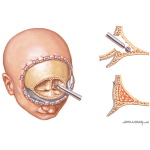 Illustration of Surgical Procedures: Frontal Sinus Obliteration from the Netter Collection