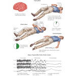 Generalized Tonic Clonic Seizures