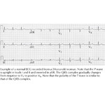 Normal Electrocardiograph