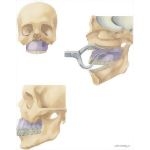 Facial Trauma: Repair of Le Fort I Fracture