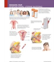 Types of Abnormal Uterine Bleeding
