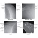 Radiology of the Shoulder