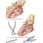 Illustration of Closed Mitral Commissurotomy from the Netter Collection